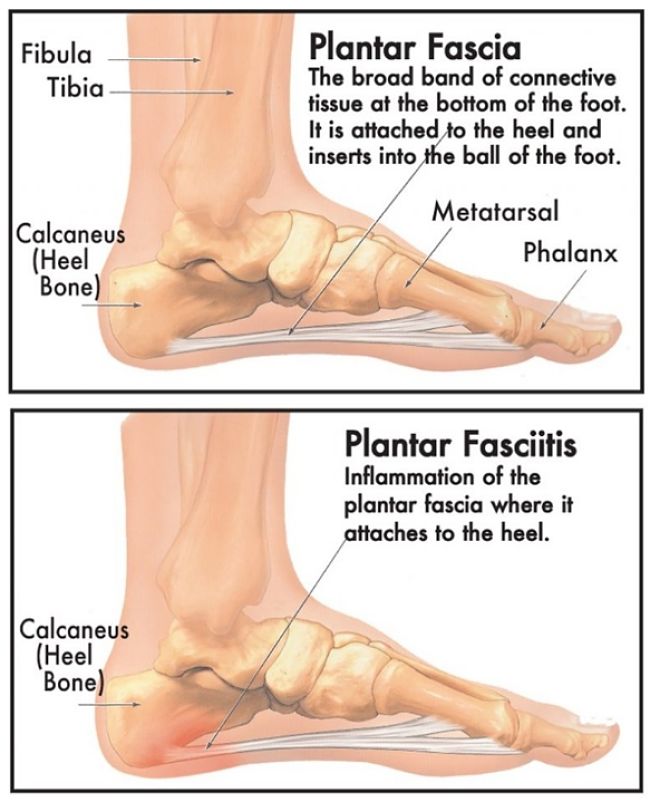 Lack or arch support and foot strike position can lead to many painful stress injuries